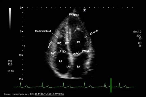 echocardiogram results interpretation|Echocardiogram: What It Shows, Purpose, Types, and Results.